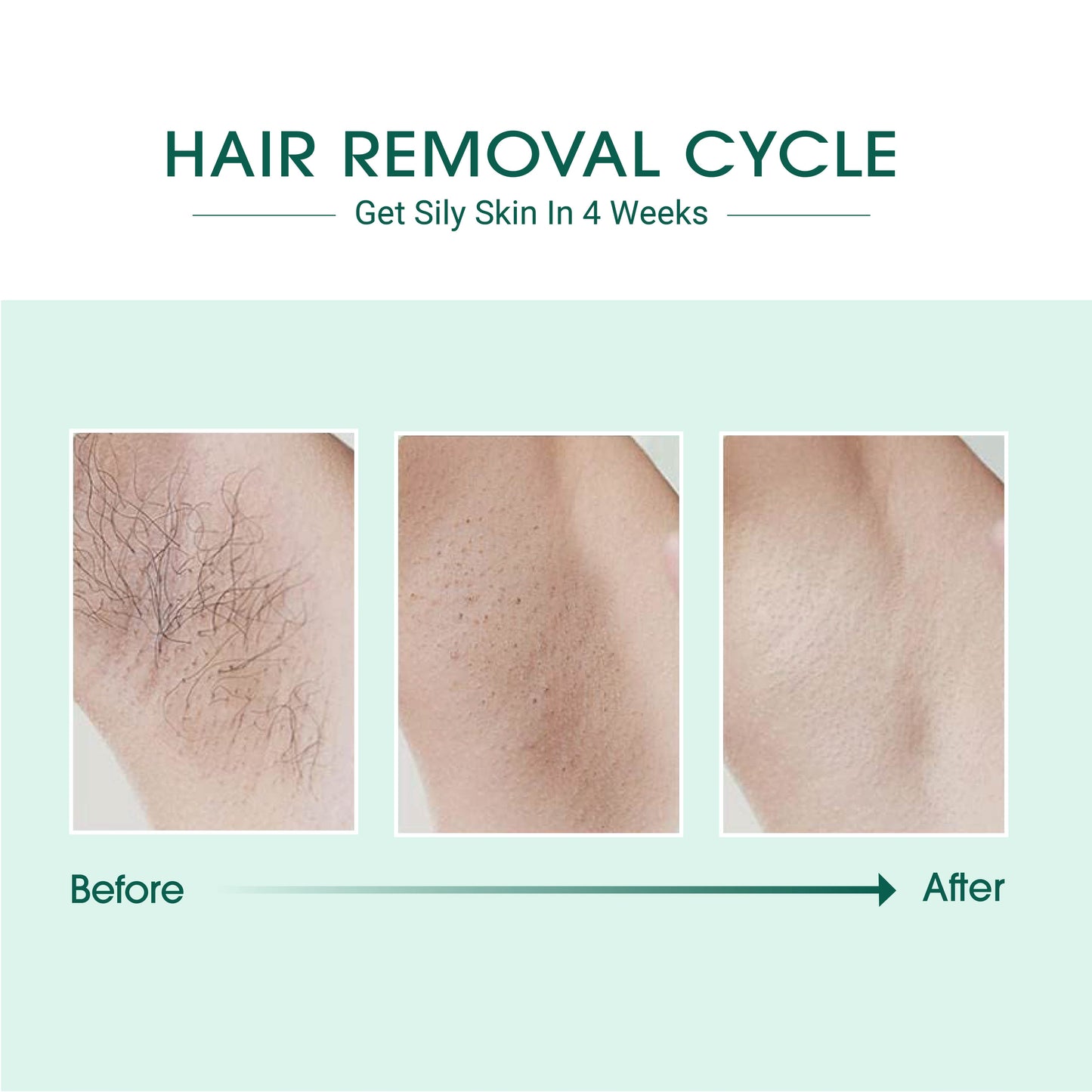 Women's Laser IPL Hair Removal